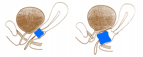 Pessar kostkowy perf. z guzikiem Dr. Arabin, 2/32 mm