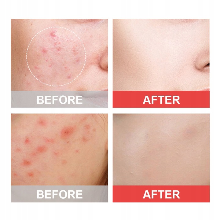 Plastry hydrokoloidowe na wypryski pryszcze 72 szt