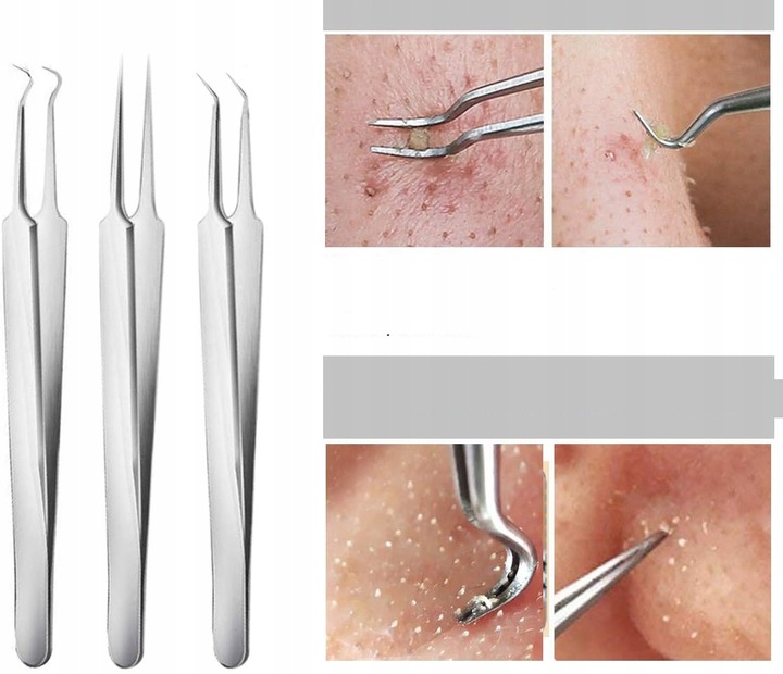 10× łyżeczki UNNY pęseta igła do usuwania zaskórników wągrów pryszczy