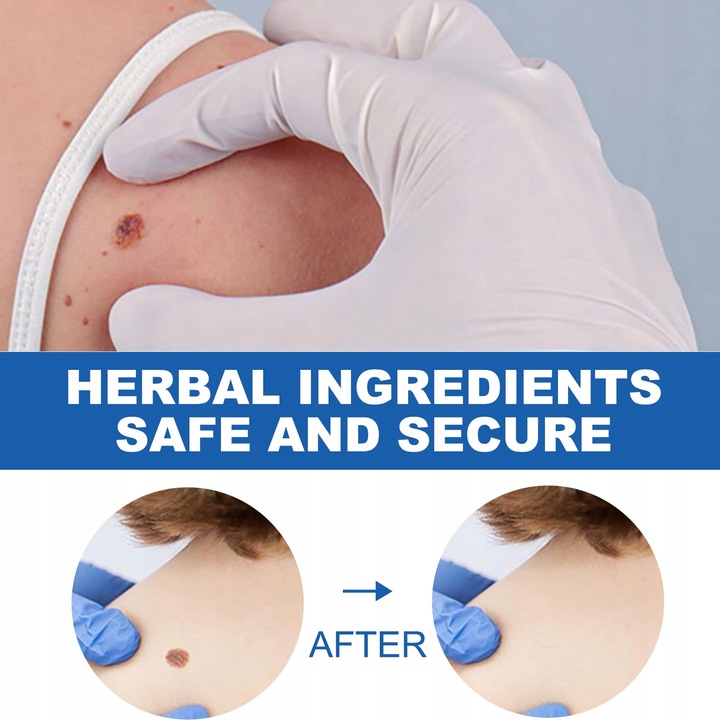 Oryginalne Pióro Do Usuwania Brodawek